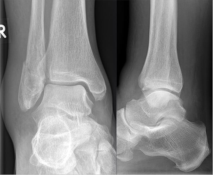 Displaced Trimalleolar Ankle Fracture