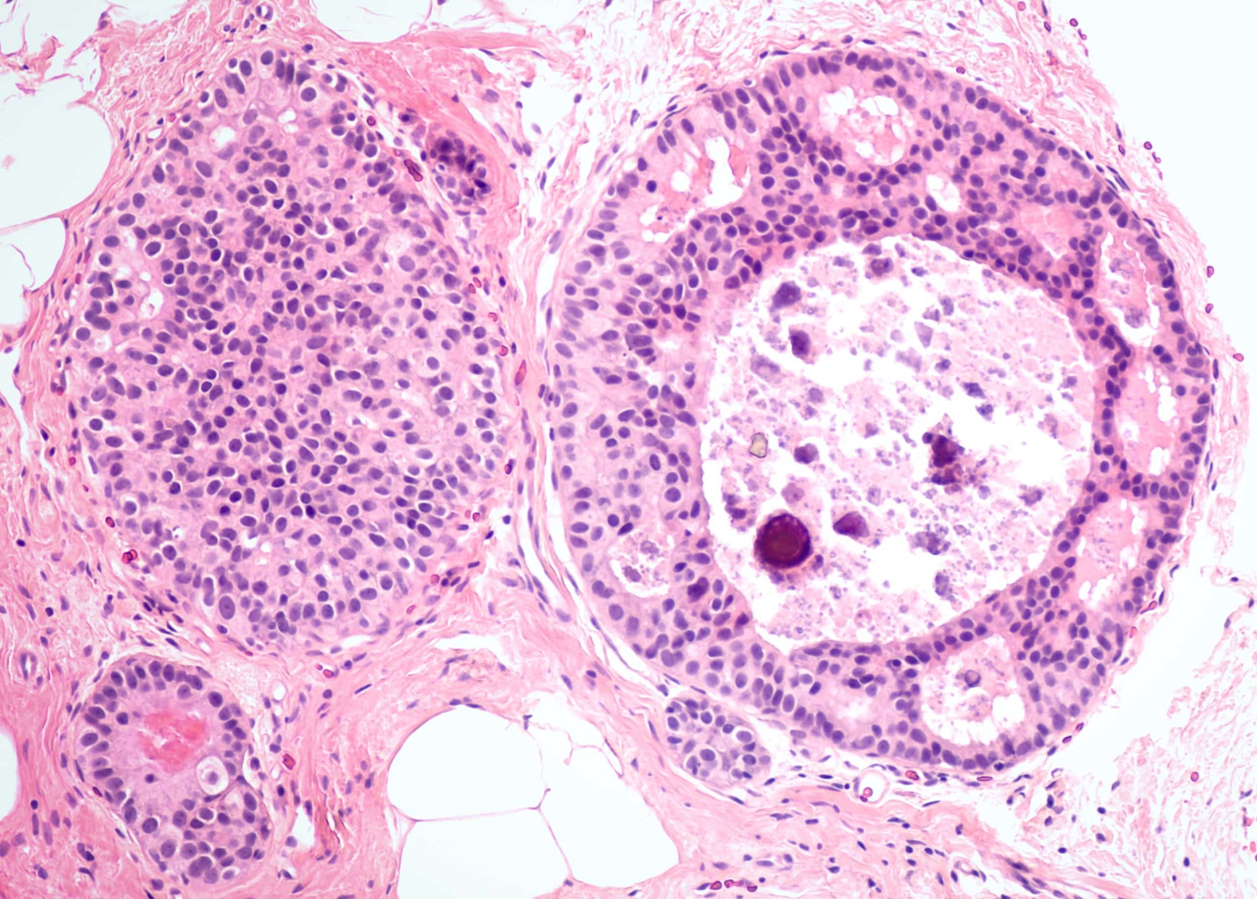 Breast Carcinoma in Situ Lobular Ductal LCIS DCIS TeachMeSurgery