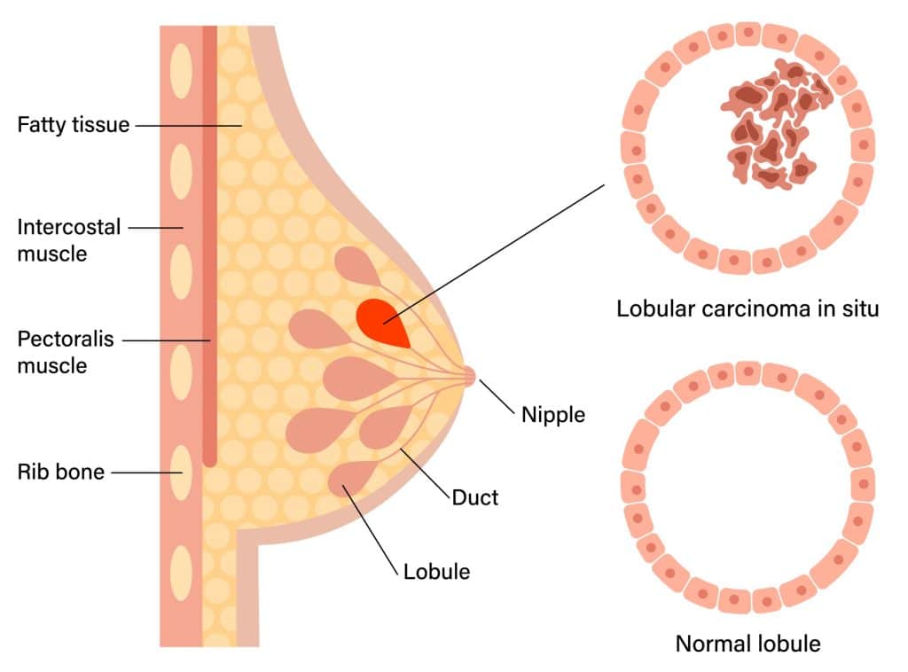 Breast Carcinoma in Situ Lobular Ductal LCIS DCIS TeachMeSurgery