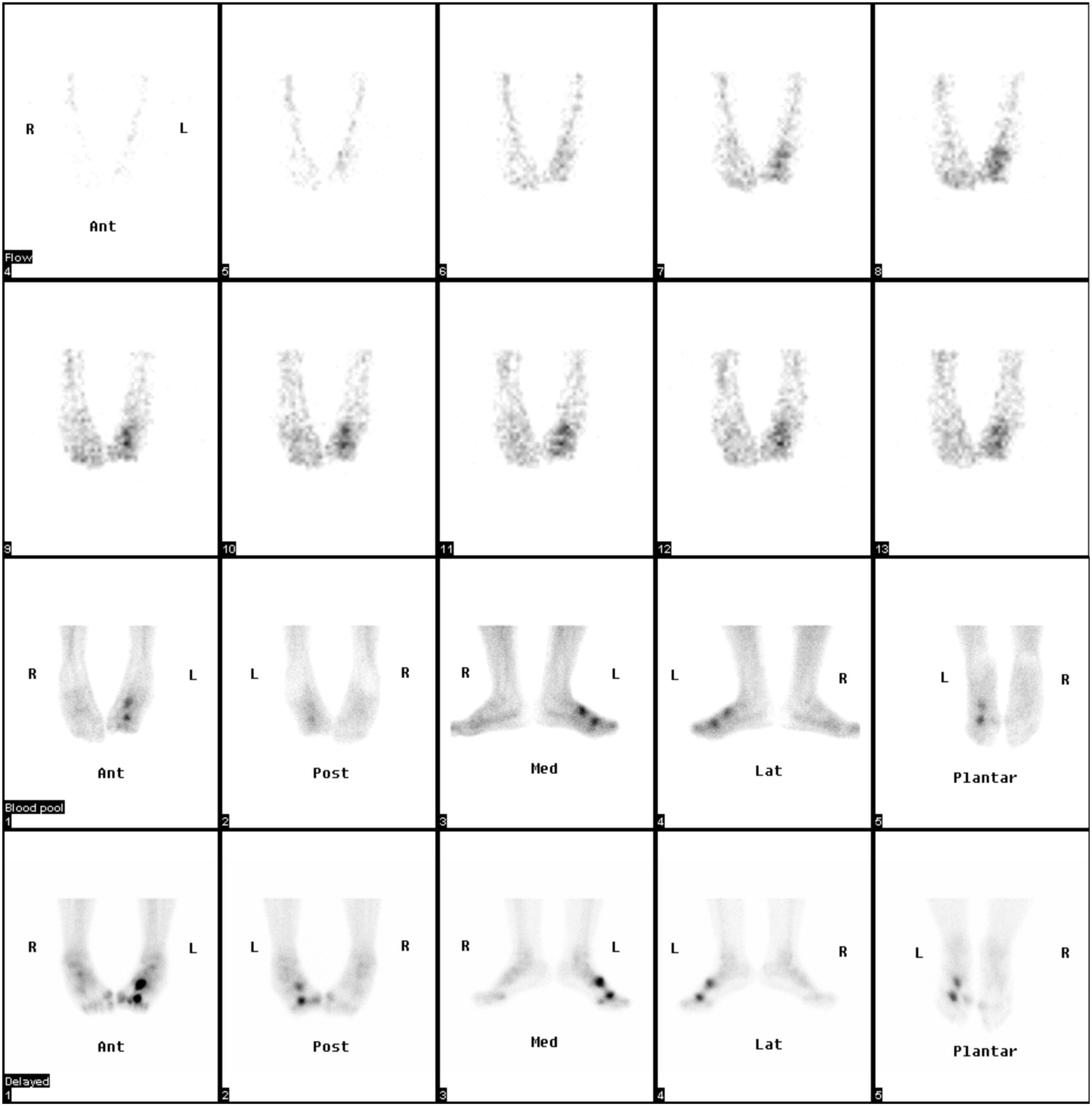 Optimal Imaging Positions for 3Phase Bone Scanning of Patients with