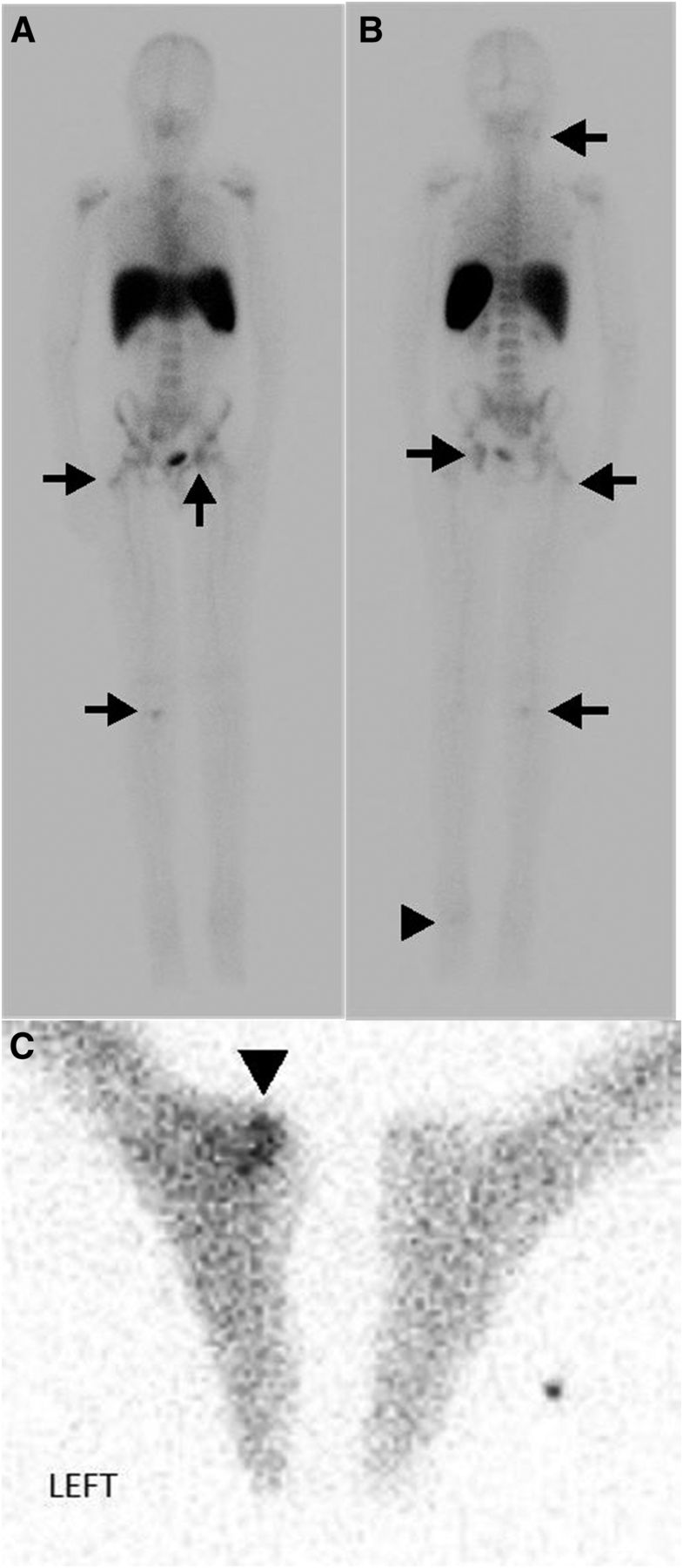 99mTcHMPAOLabeled WBC Scan for the Diagnosis of Chronic Recurrent