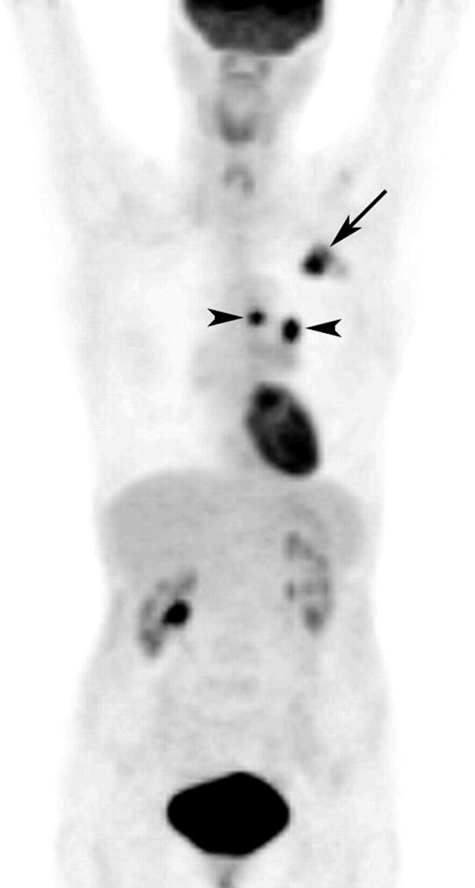 Pet Scan Images Lung Cancer