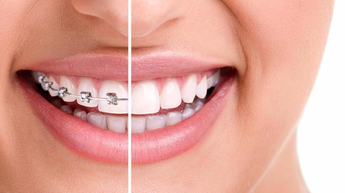 What is the average cost of braces? Techeduhp