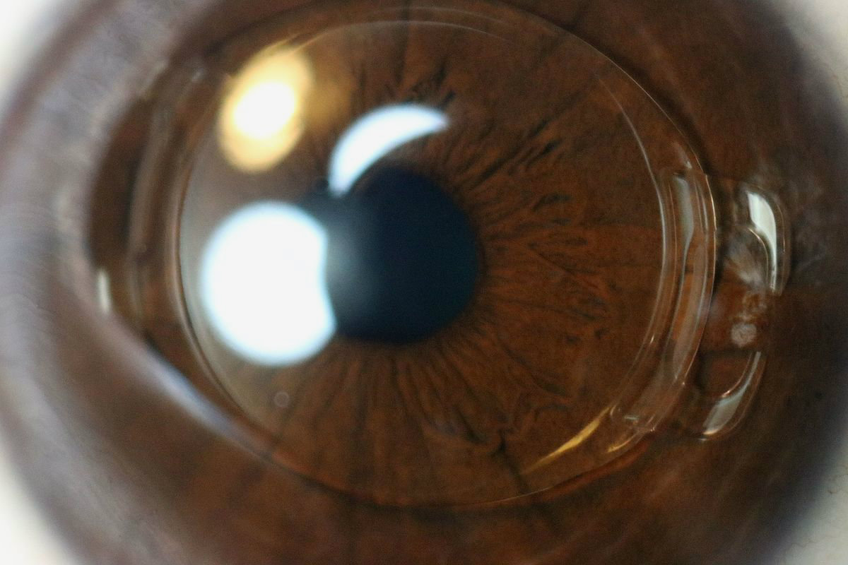 Medical Device Cleaning Soft Acrylic Intraocular Lenses (IOLs) TechNotes