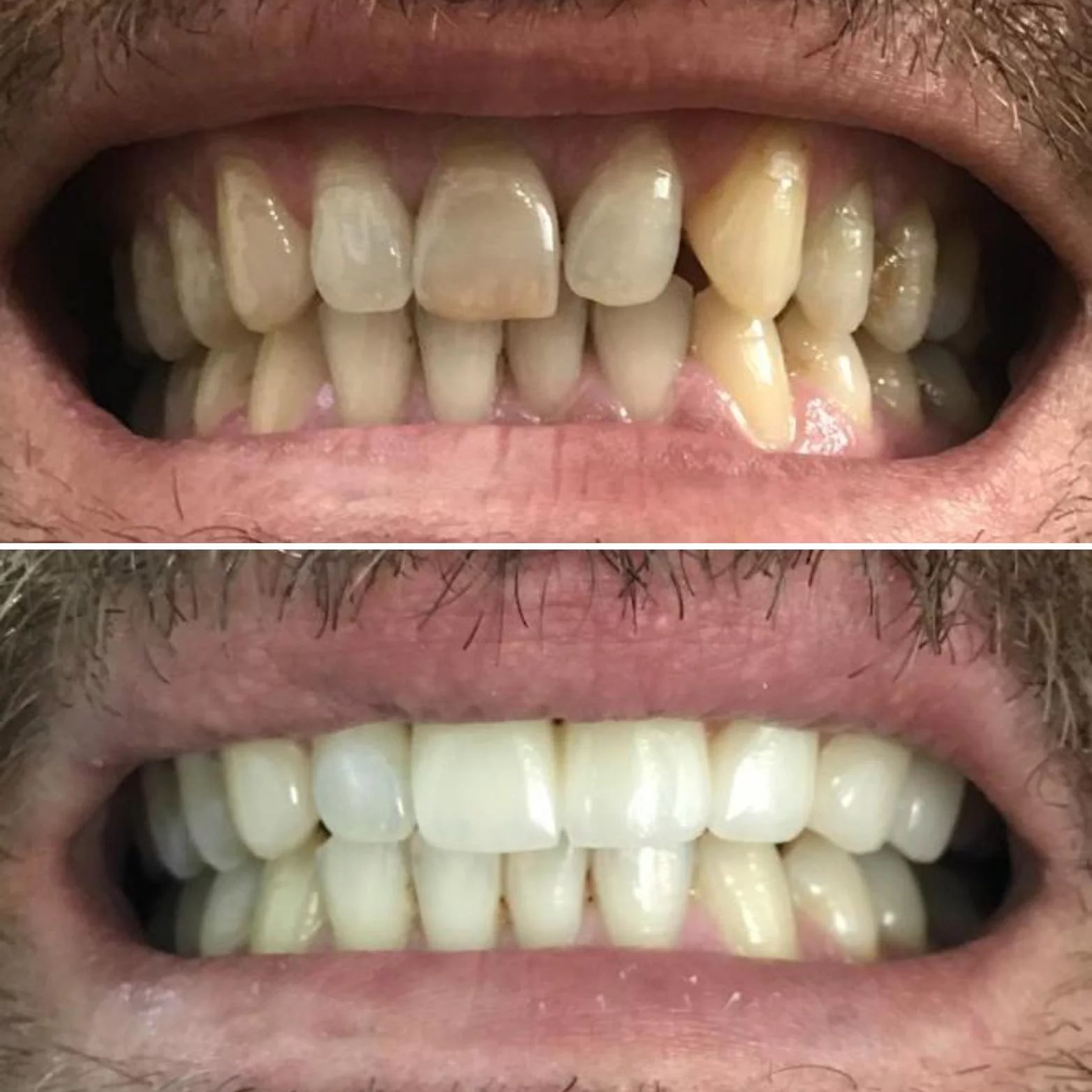 Porcelain Tooth Veneer Tedder Global