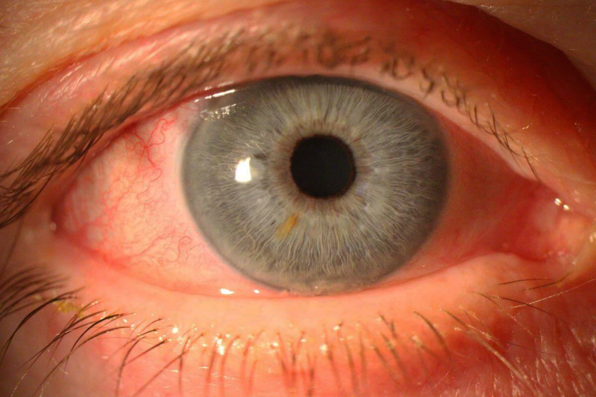 The Mysterious “Pink Eye” AKA Conjunctivitis Teeple Optometry