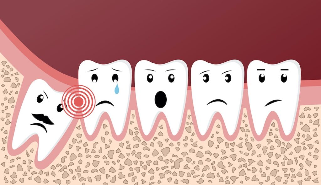 What Are the Benefits of Keeping Wisdom Teeth? Teethandtooth
