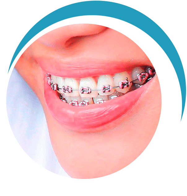 Brackets de Autoligado Ventajas Tipos de Ortodoncia