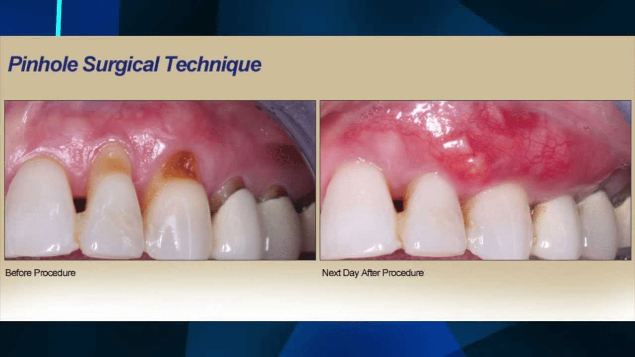 PinHole Graft Technique for Gingival Recession OneSolution Dental
