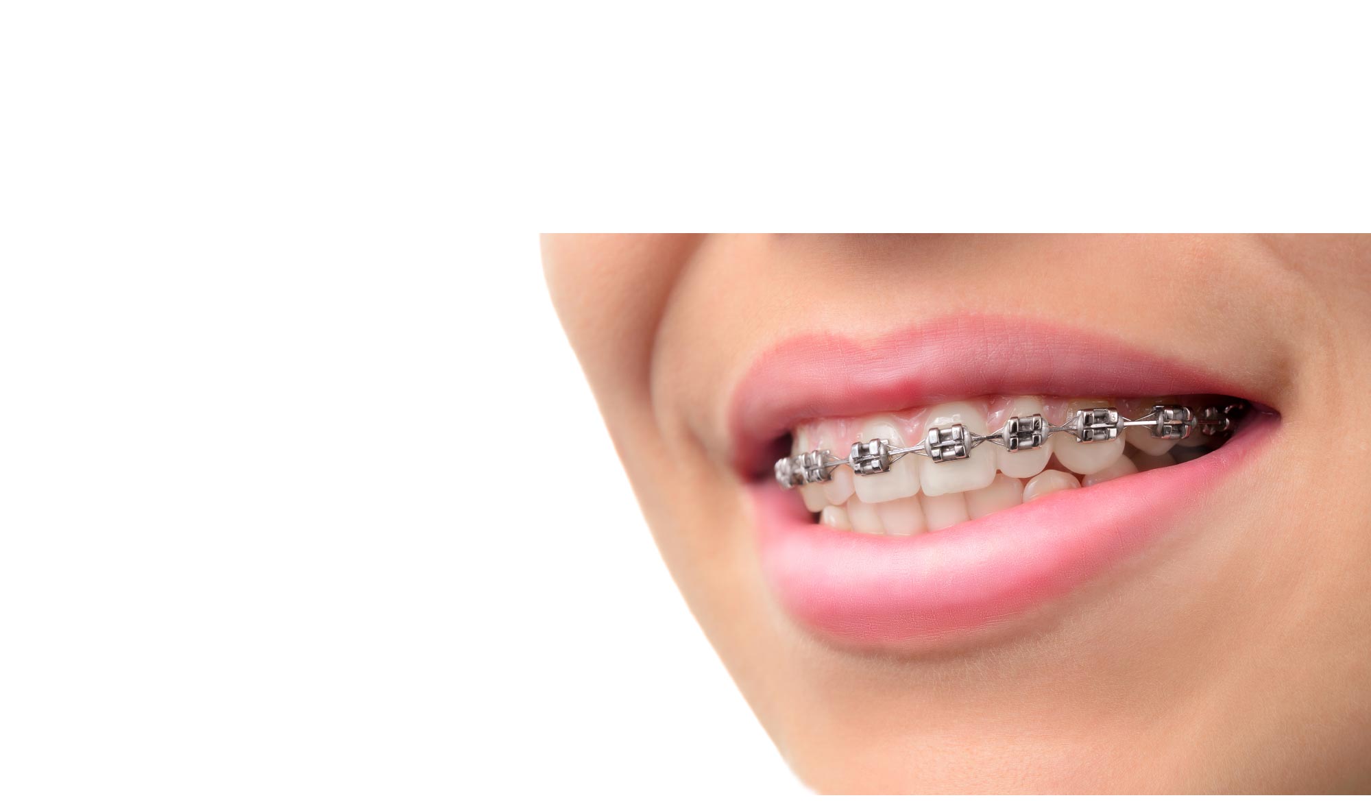 Fixed Metal Braces Teeth In Line