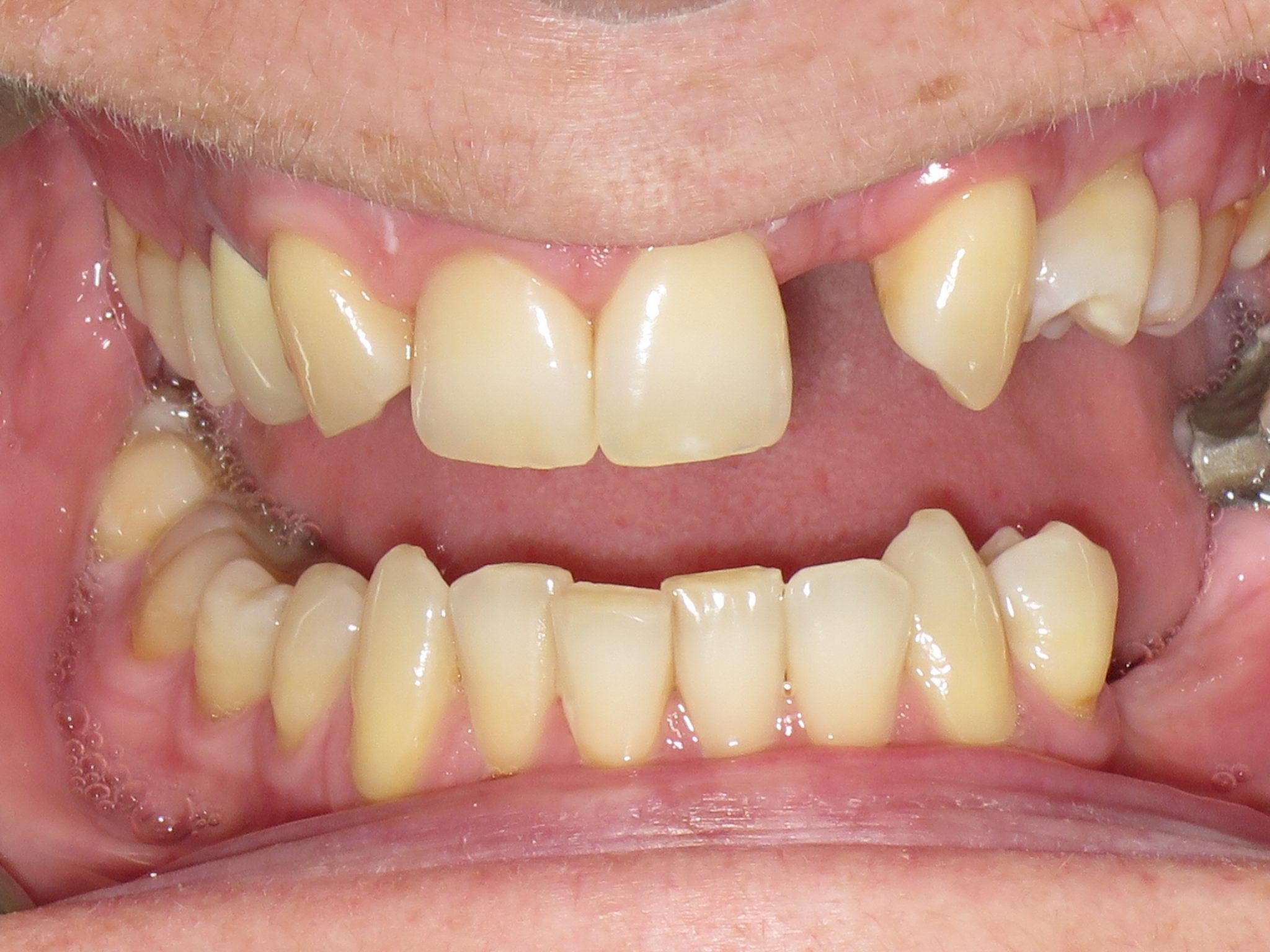 Missing Teeth Teeth In Line