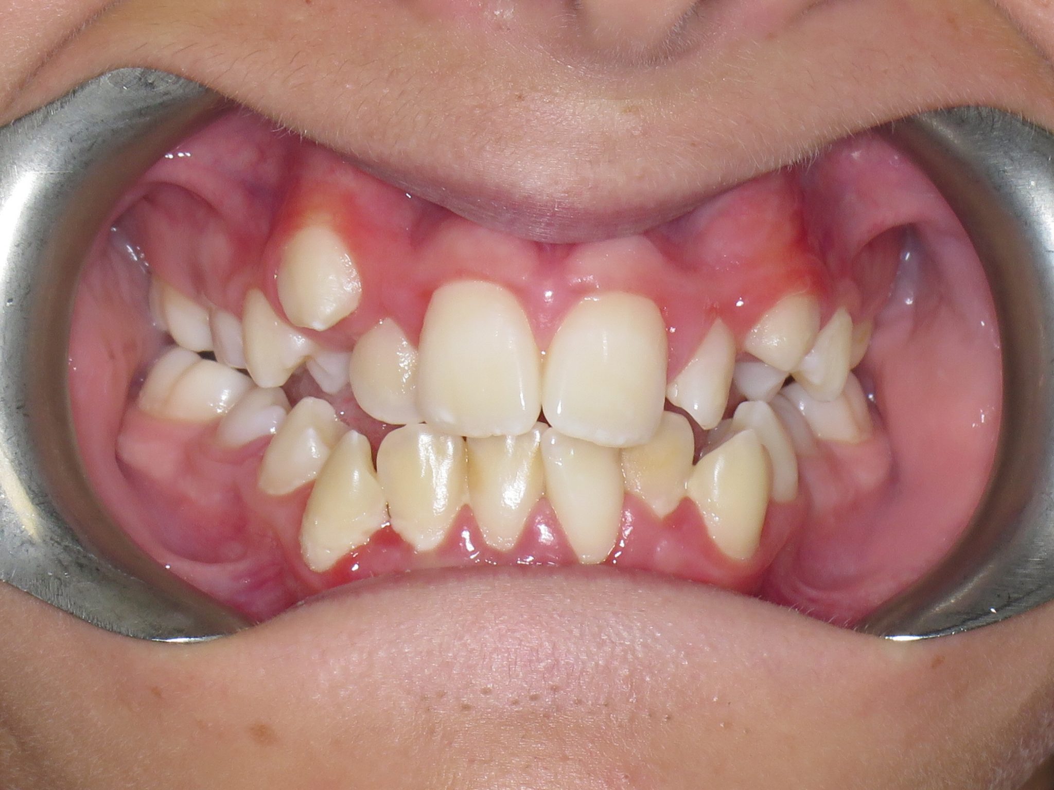 Crooked/Overcrowded Teeth Teeth In Line