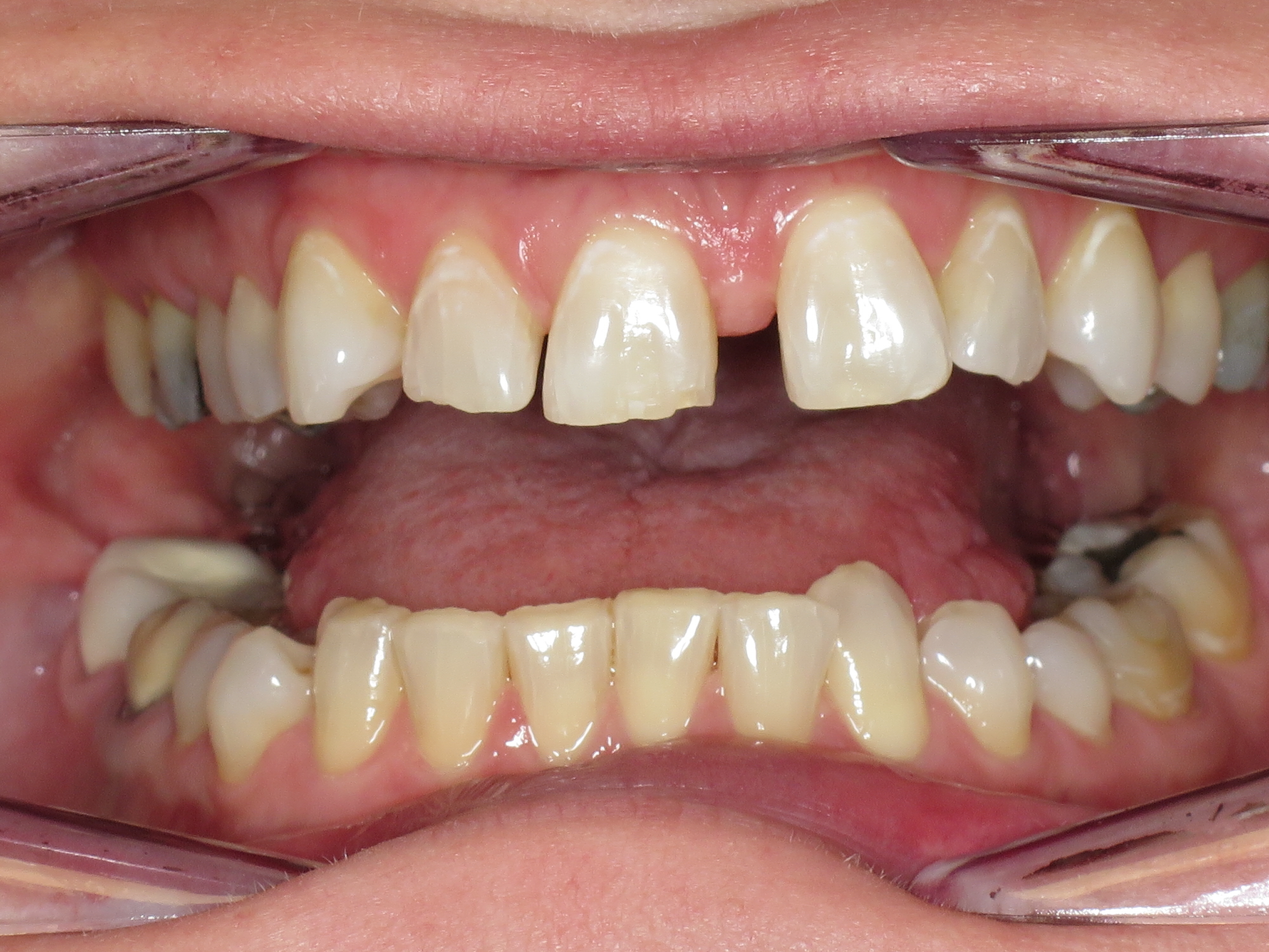 Spacing Teeth In Line