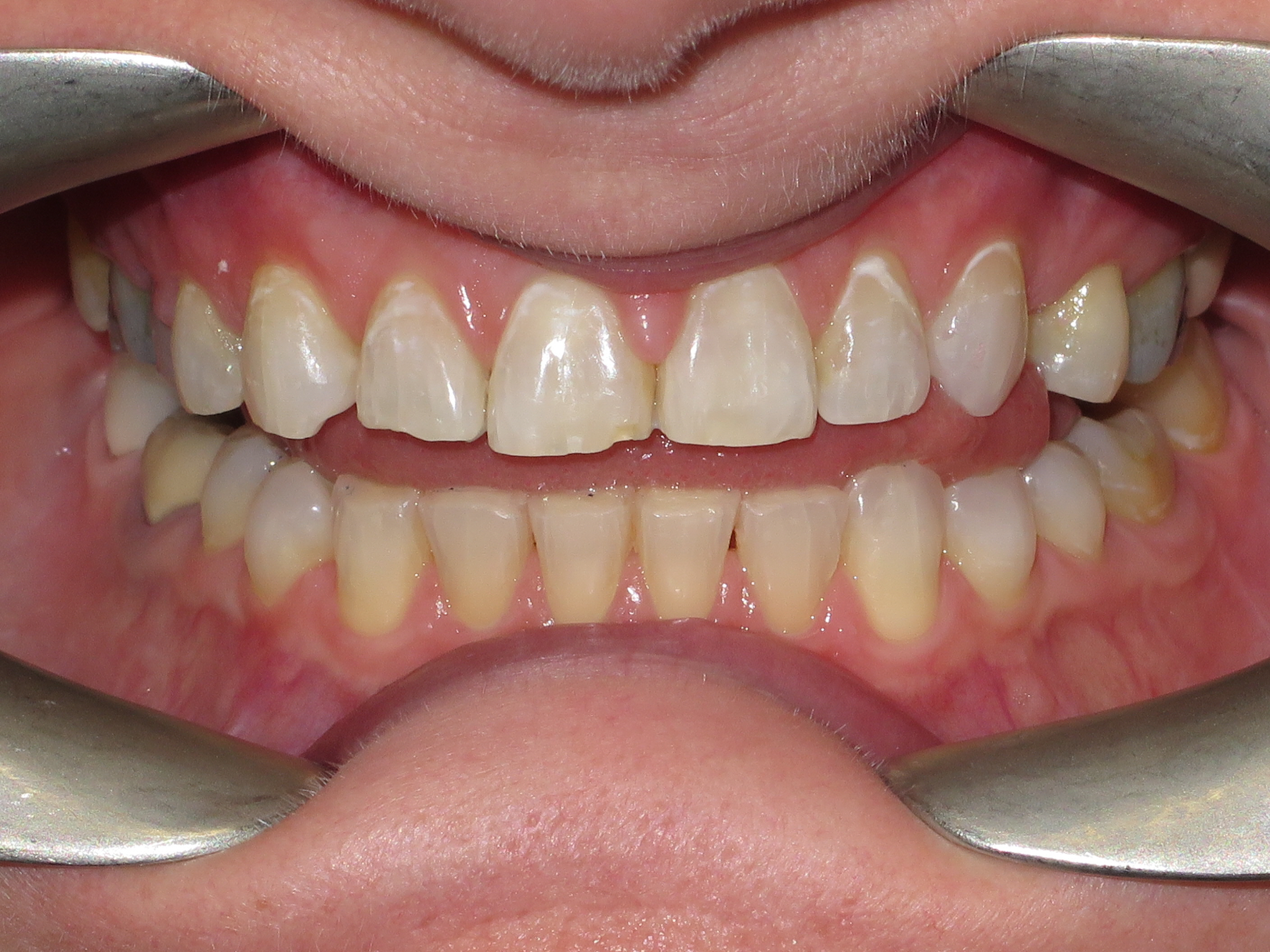 Spacing Teeth In Line