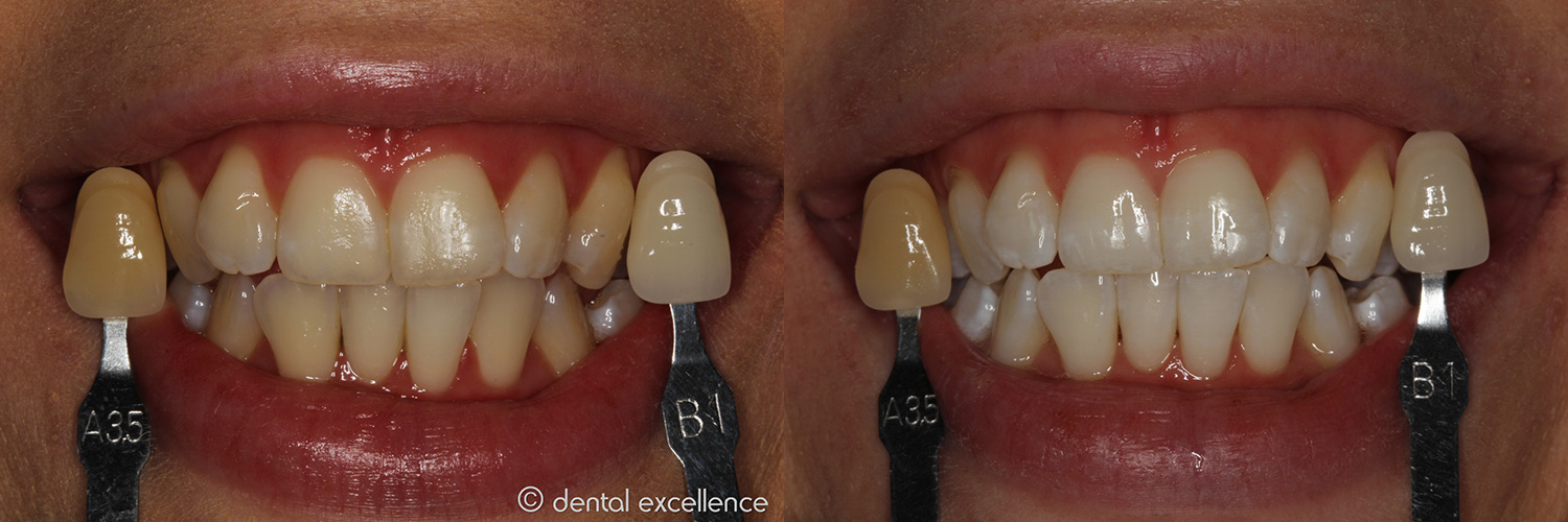Dental ExcellenceIn Chair Teeth Whitening in Perth In Office Teeth
