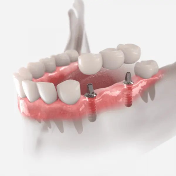 Permanent Dentures Types, Pros, Cons & Costs Teeth Wisdom