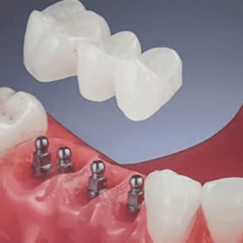 Everything You Need to Know About Mini Dental Implants Teeth Wisdom