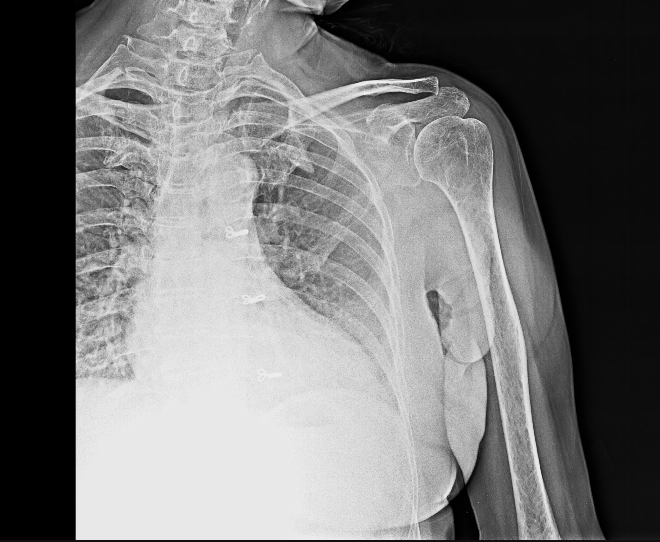 XRAY DORSAL SPINE(AP & LAT) Teleradwin