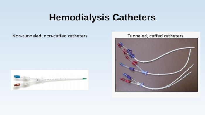 Non Tunneled Catheter Vs Tunneled Catheter
