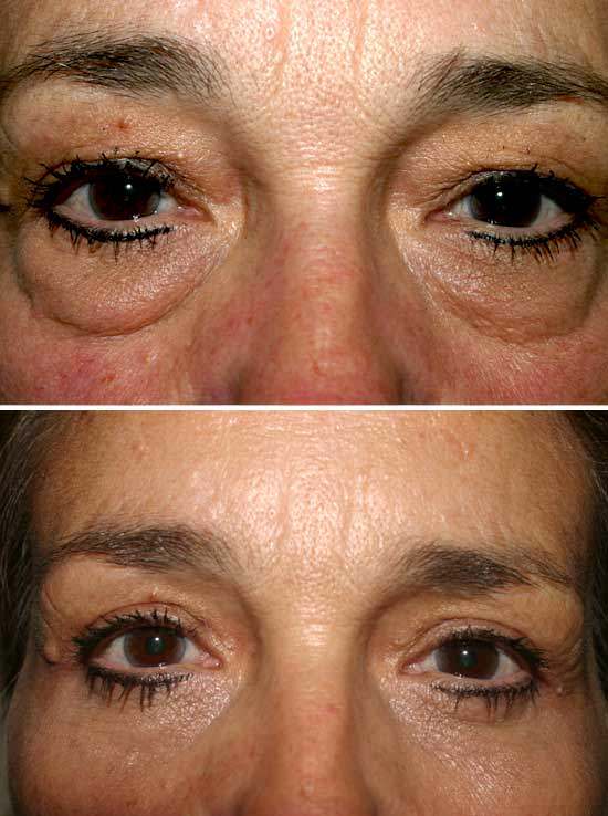 Eyelid Surgery 01 Temecula Plastic Surgery