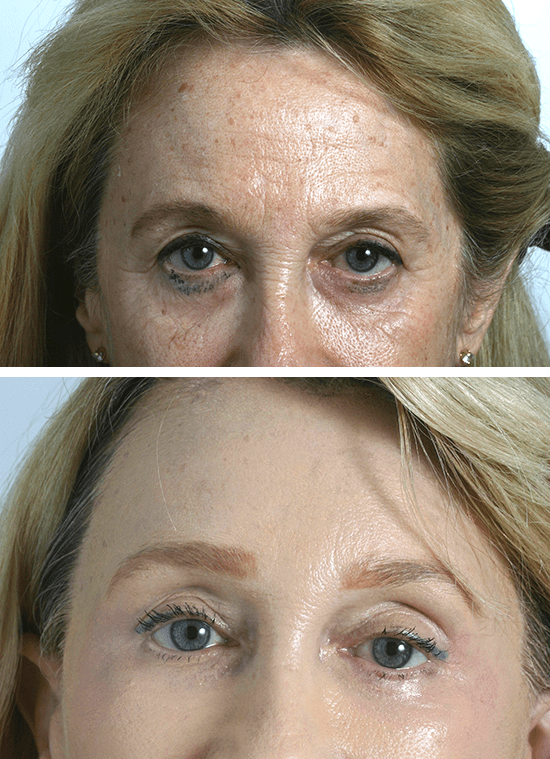 Brow Lift 9 Temecula Plastic Surgery