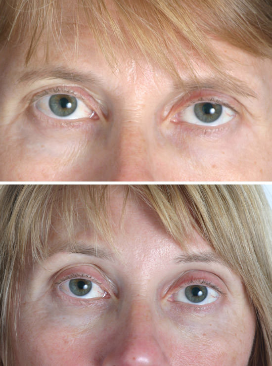 Brow Lift 08 Temecula Plastic Surgery