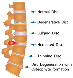 Spinal Decompression Therapy Treats Degenerative, Bulging and Herniated Discs