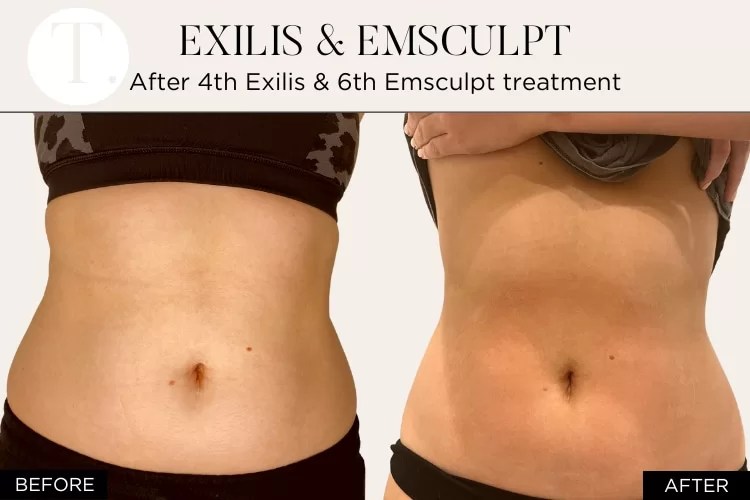 Fat Reduction 50 off your first Body Fat Reduction treatment