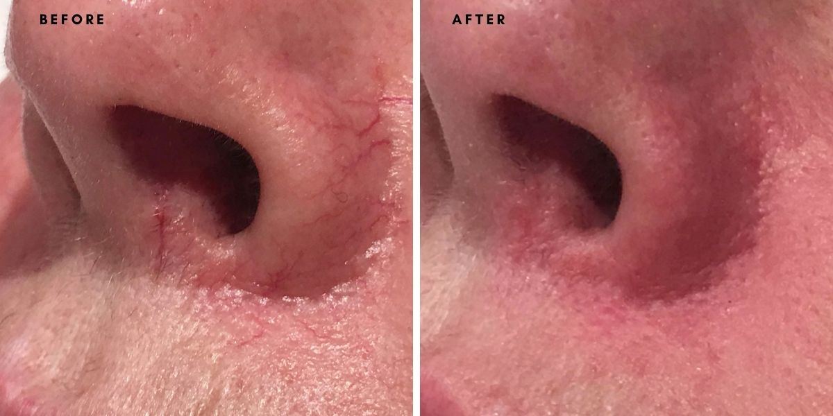 Broken Capillaries, Spider Veins, Visible Vessels and Sun Spots Laser