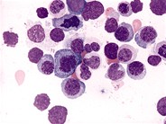 Refractory Anemia with Ring Sideroblasts 2.