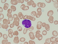 Refractory anemia with excess blasts2 (RAEB2) 1