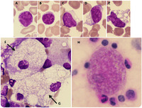 Morphology of NiemannPick type A metabolic storage disorder
