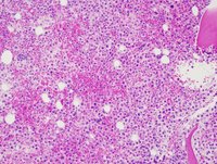 A gelatinous leukemia