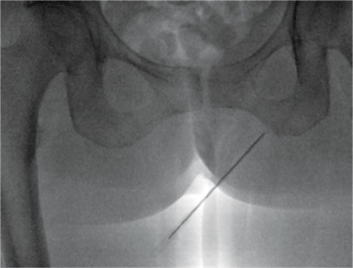Pudendal Nerve Block Anesthesia Key