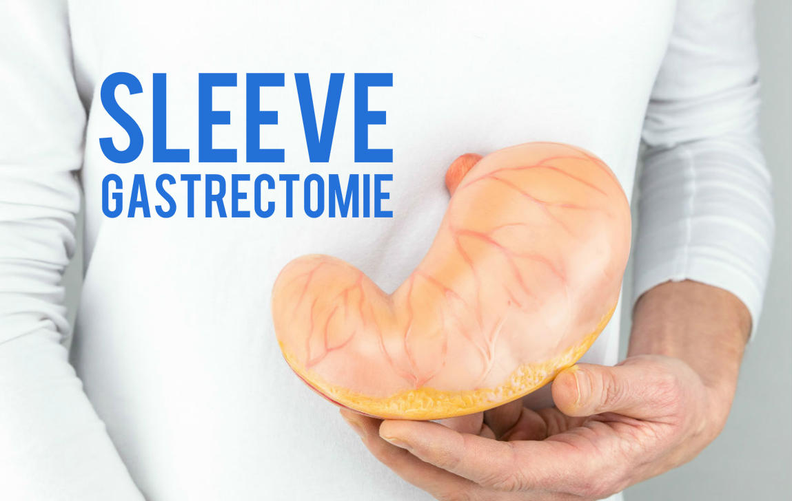 Sleeve gastrectomie ou la chirurgie bariatrique