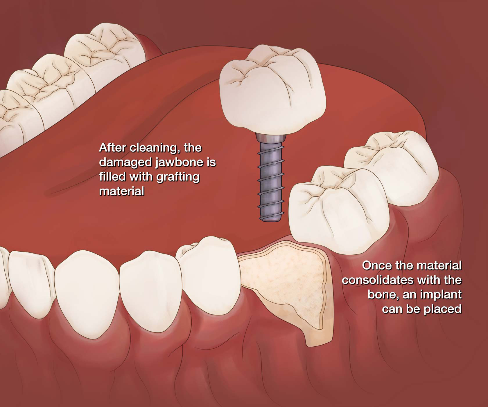 bonegrafting Teton Oral Surgery