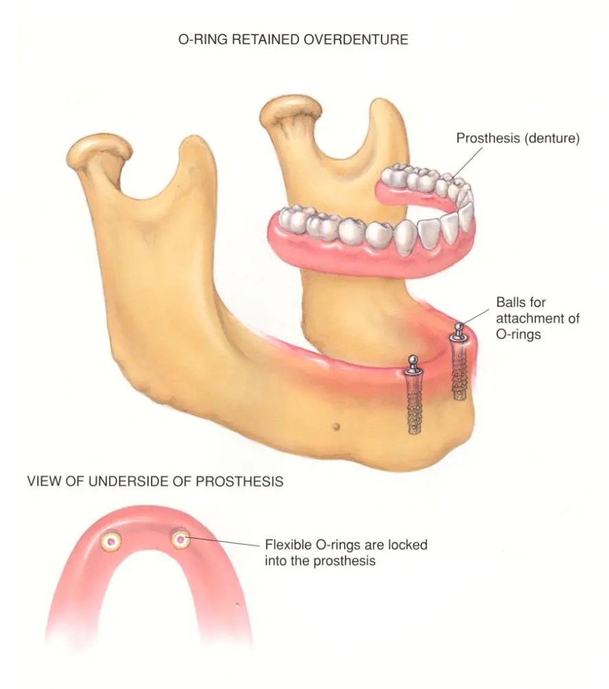 All on 4 All on Four Dental Implants Permanent Teeth