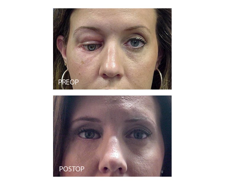 Eye Removal (Enucleation) » Dallas Ophthalmology Surgeons Texas