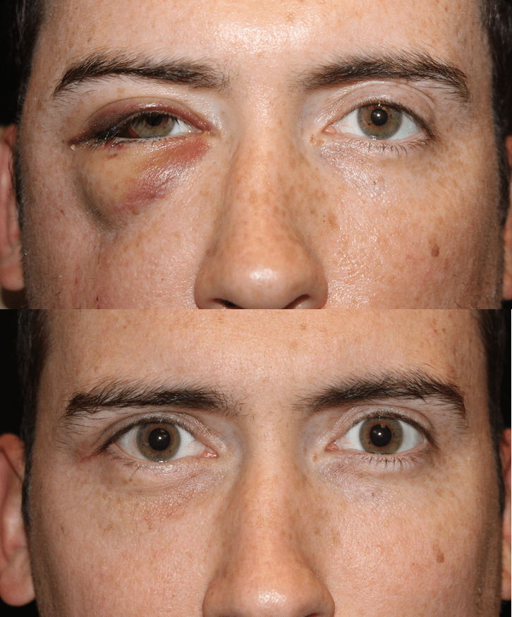 Trauma Repair/Reconstruction » Dallas Ophthalmology Surgeons Texas Ophthalmic Plastic Surgery
