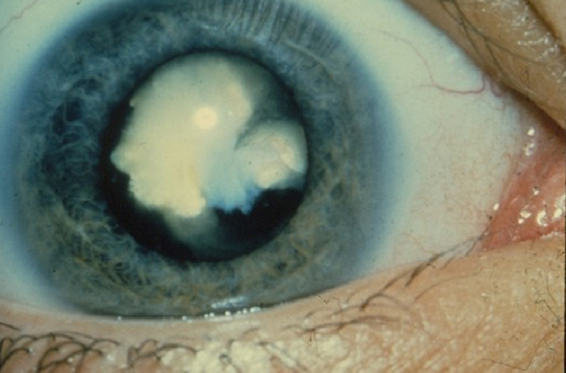 Fort Worth Clinic Offers LifeChanging Eye Surgery for Free