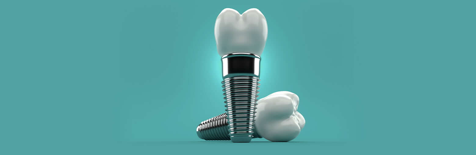 Dental Implants Spring, TX Texas Star Dental
