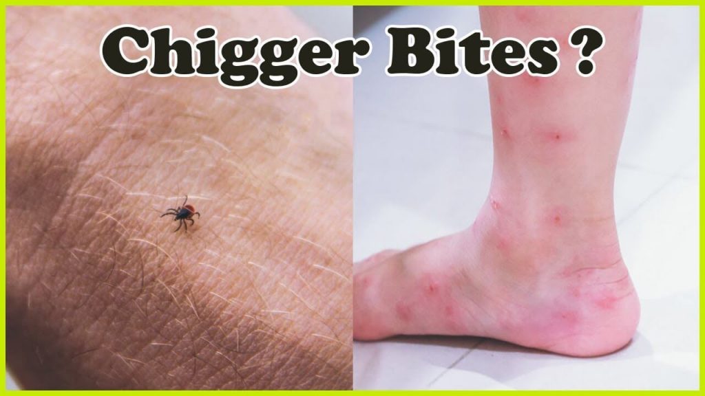 Can Chiggers Live On Sheets at Stanley Lesley blog