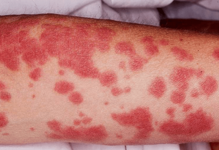 DRESS Serious skin reaction with Olanzapine thasso