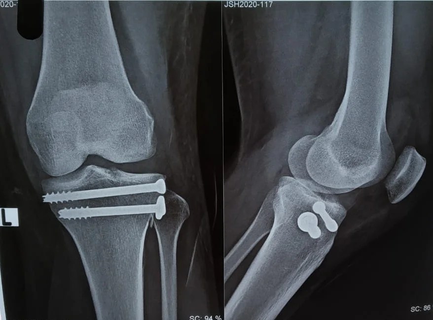 Knee fracture Upper Tibia that ortho doctor