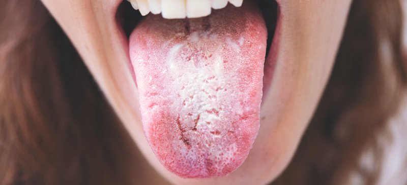 Yeast Overgrowth? Thats Health