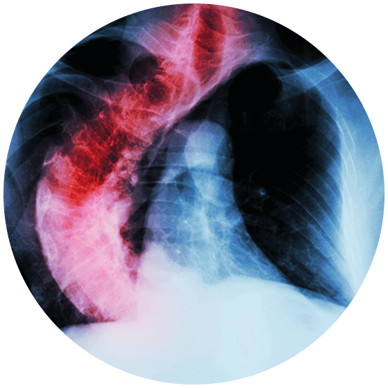 Spinal Deformities Symptoms & Advanced Spine Care