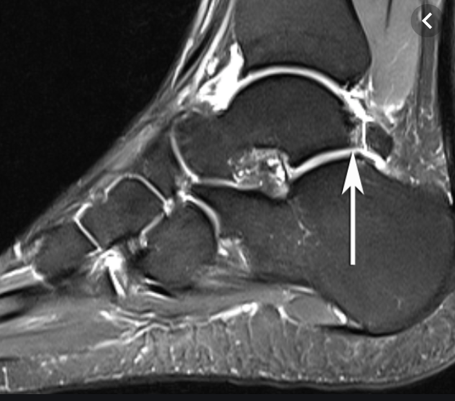 Icd Code 10 For Right Ankle Pain