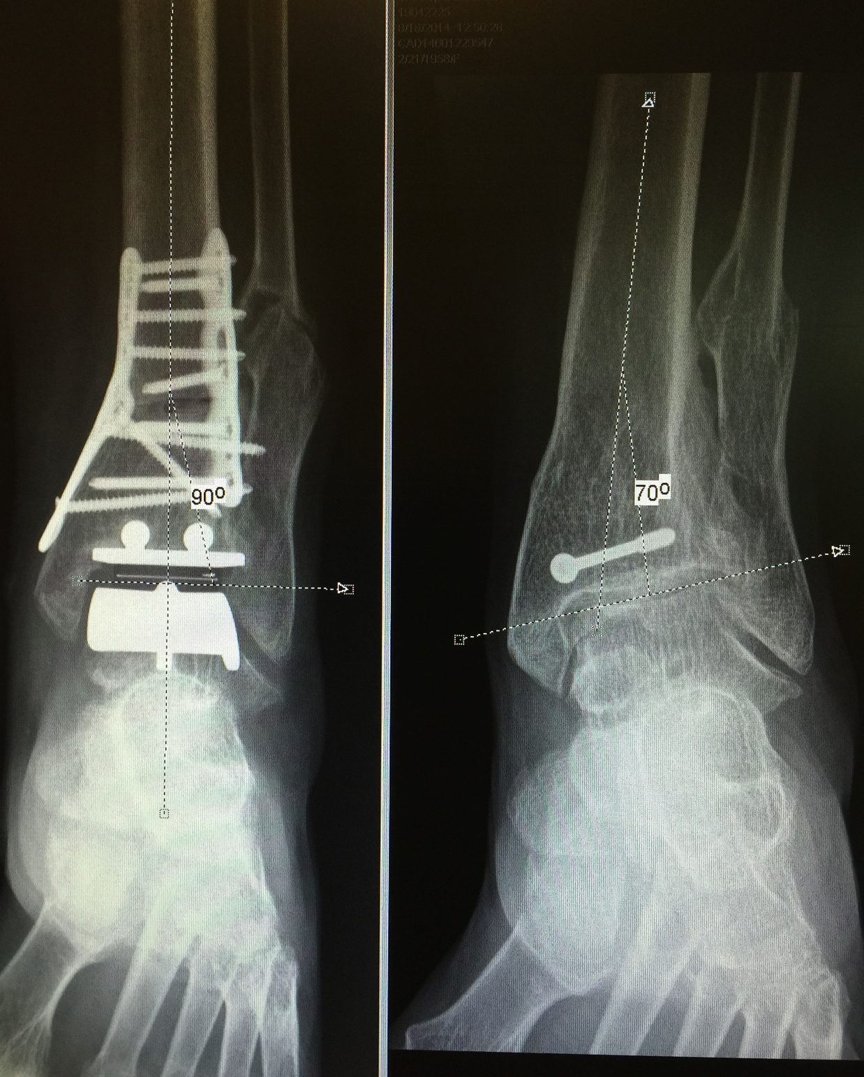 The Ankle Surgeon What You Need to Know About Ankle Replacement
