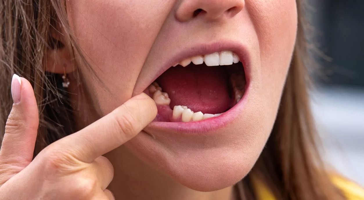 When Can I Drink Alcohol After Tooth Extraction?