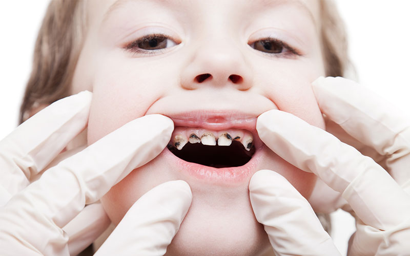 Gluten + Tooth Decay What You Should Know The Blogging Doctors